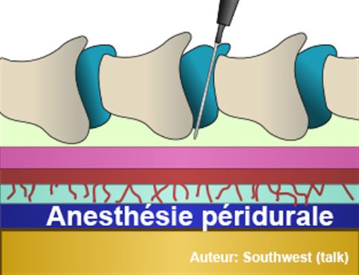 Anesthésie péridurale