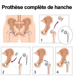 prothèse de la hanche