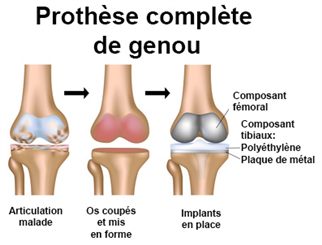 prothèse du genou
