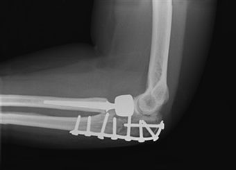 fracture du coude