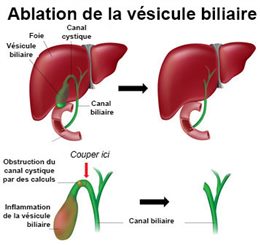ablation de la vésicule biliaire