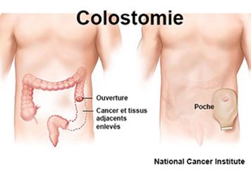 côlostomie