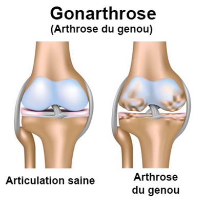 Définition, symptômes et diagnostic de l'arthrose du genou