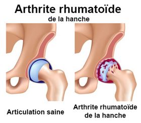 athrite de la hanche