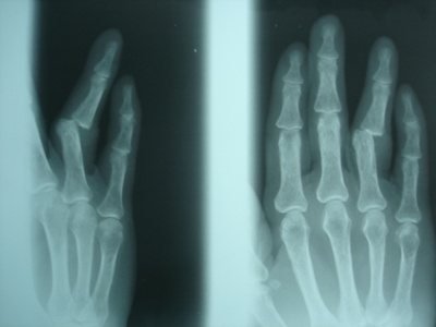 Luxation d'un doigt (rando, trek, montagne) : symptômes, traitement