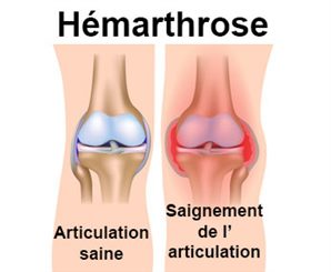 hémarthrose