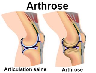 arthrose
