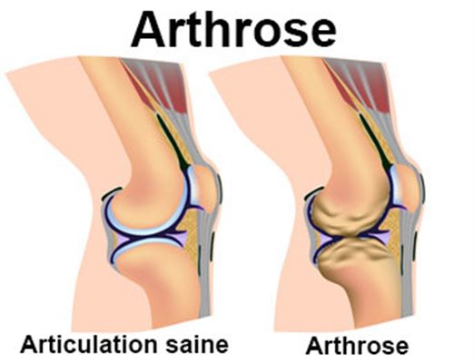 Traitements de l'arthrose