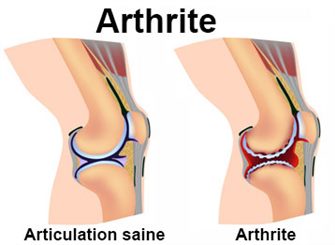 arthrite