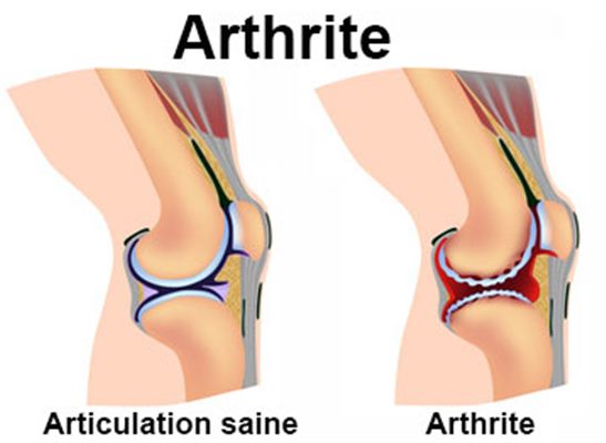 Arthrites
