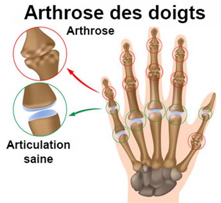 Arthroses des doigts