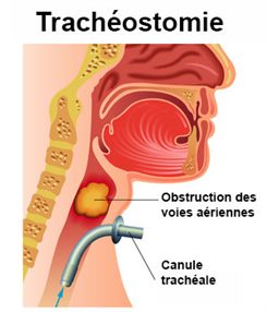 trachéostomie
