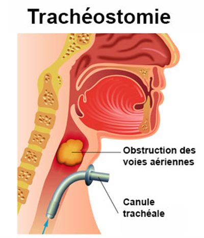 Trachéostomie