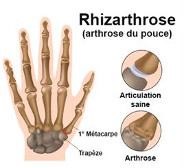 arthrose du pouce