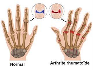 arthrite de la main