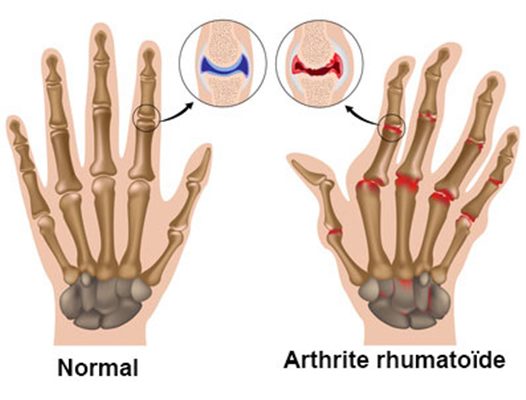 Ostéo-arthrites