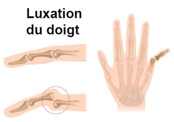 luxation d'un doigt