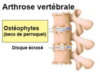 ostéophytes