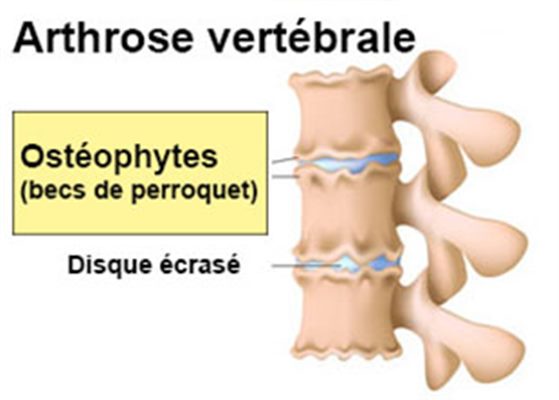 Ostéophytes