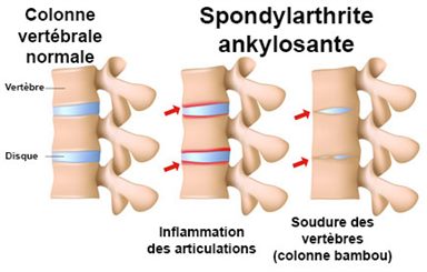 spondylarthrite ankylosante