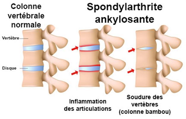 Syndrome de Fiessinger-Leroy-Reiter