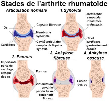 Polyarthrite rhumatoÏde (témoignage de malade)