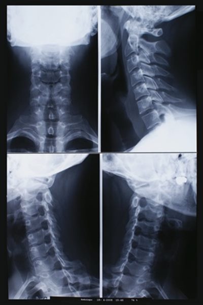 Arthrose cervicale : symptômes, traitement, définition ...