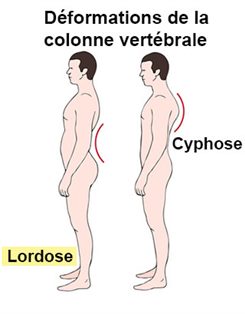 lordose