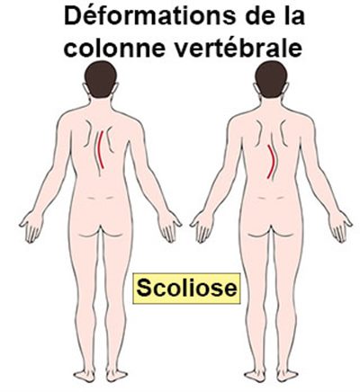 Scoliose