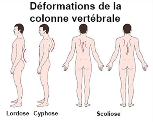 Déformations acquises de la colonne vertébrale