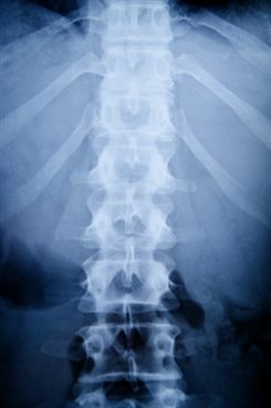 radiographie du rachis