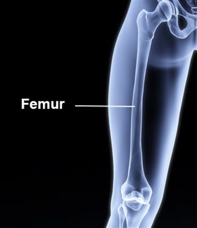 Traumatisme du fémur (rando, trek, montagne)