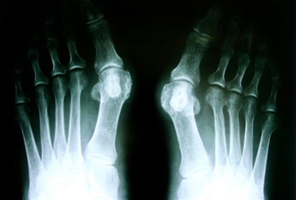 Hallux valgus