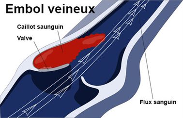 embol veineux