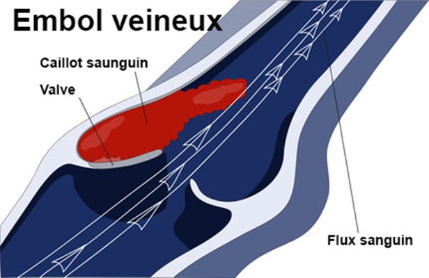 Embolie des membres inférieurs