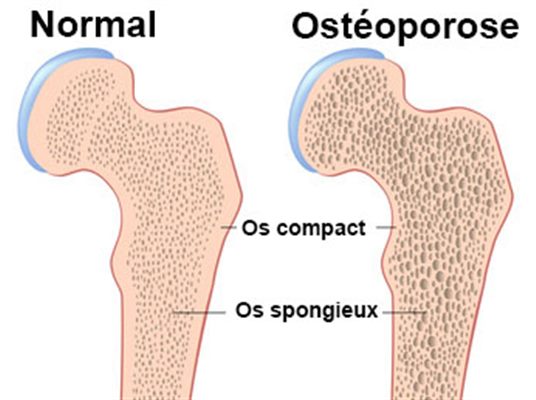 Ostéoporose : comprendre l'anatomie des os