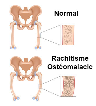 Ostéomalacie symptômes, traitement, définition