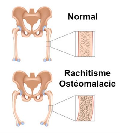 Ostéomalacie