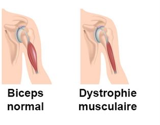 dystrophie musculaire