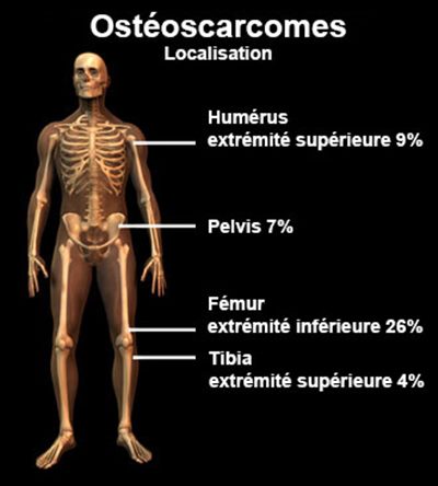 Ostéosarcomes