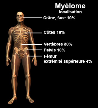 Myélome : symptômes, traitement, définition - docteurclic.com
