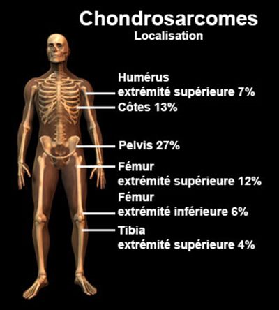 Chondrosarcomes