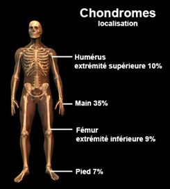chondrome