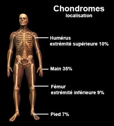 Chondromes