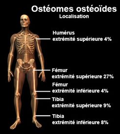 ostéomes ostéoïdes