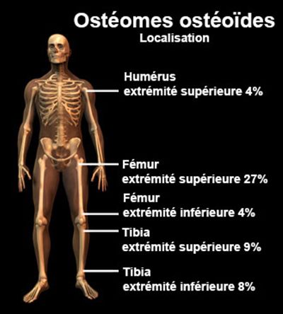 Ostéomes