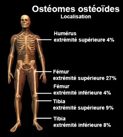 Ostéomes : symptômes, traitement, définition - docteurclic.com