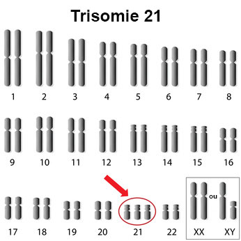Mongolisme Symptomes Traitement Definition Docteurclic Com