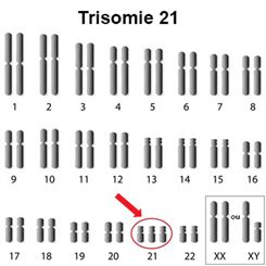 trisomie 21