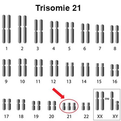 Mongolisme - Trisomie 21